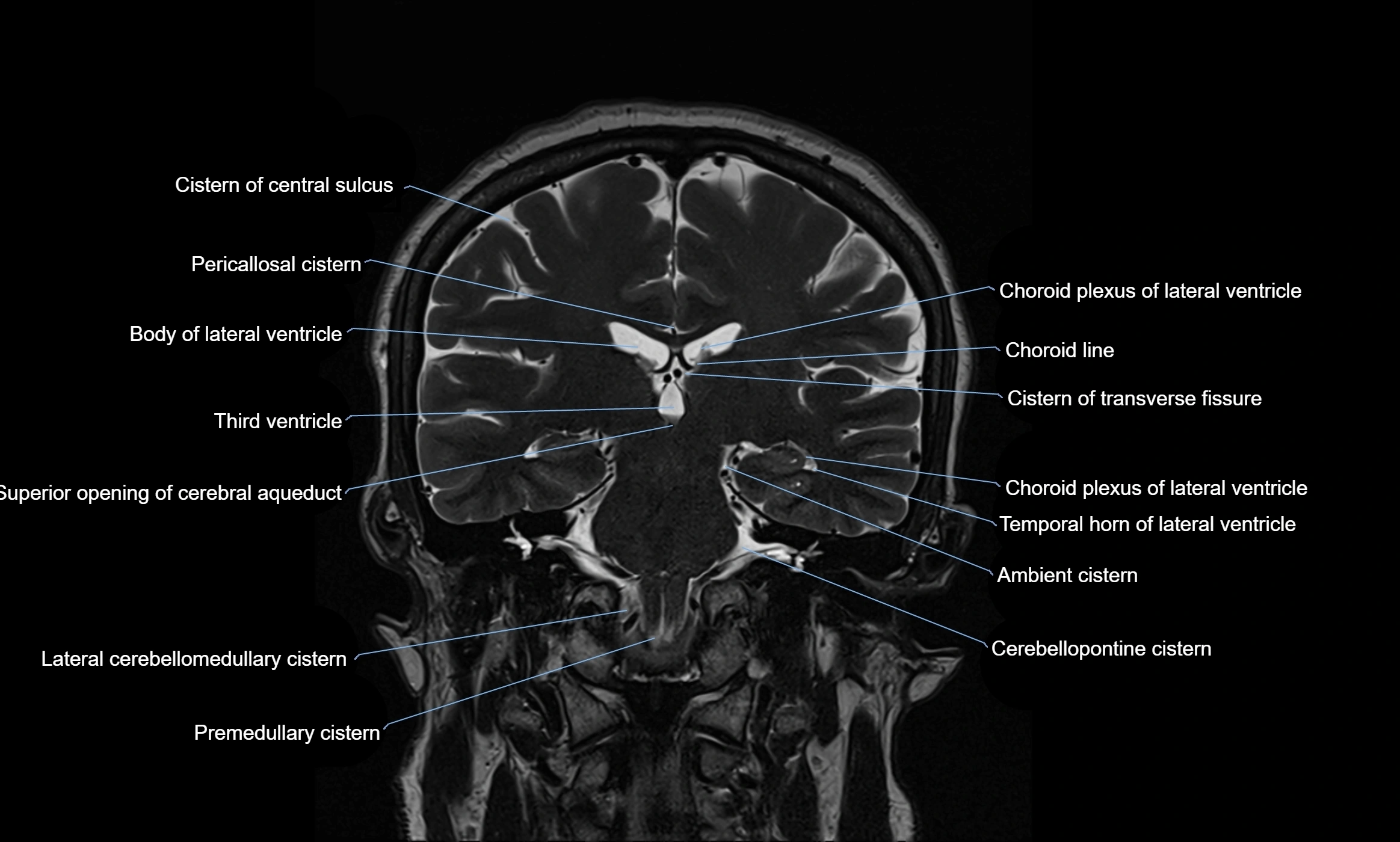 Brain cisterns  and ventricles coronal anatomy 3T MRI image-img-00001-00034.webp